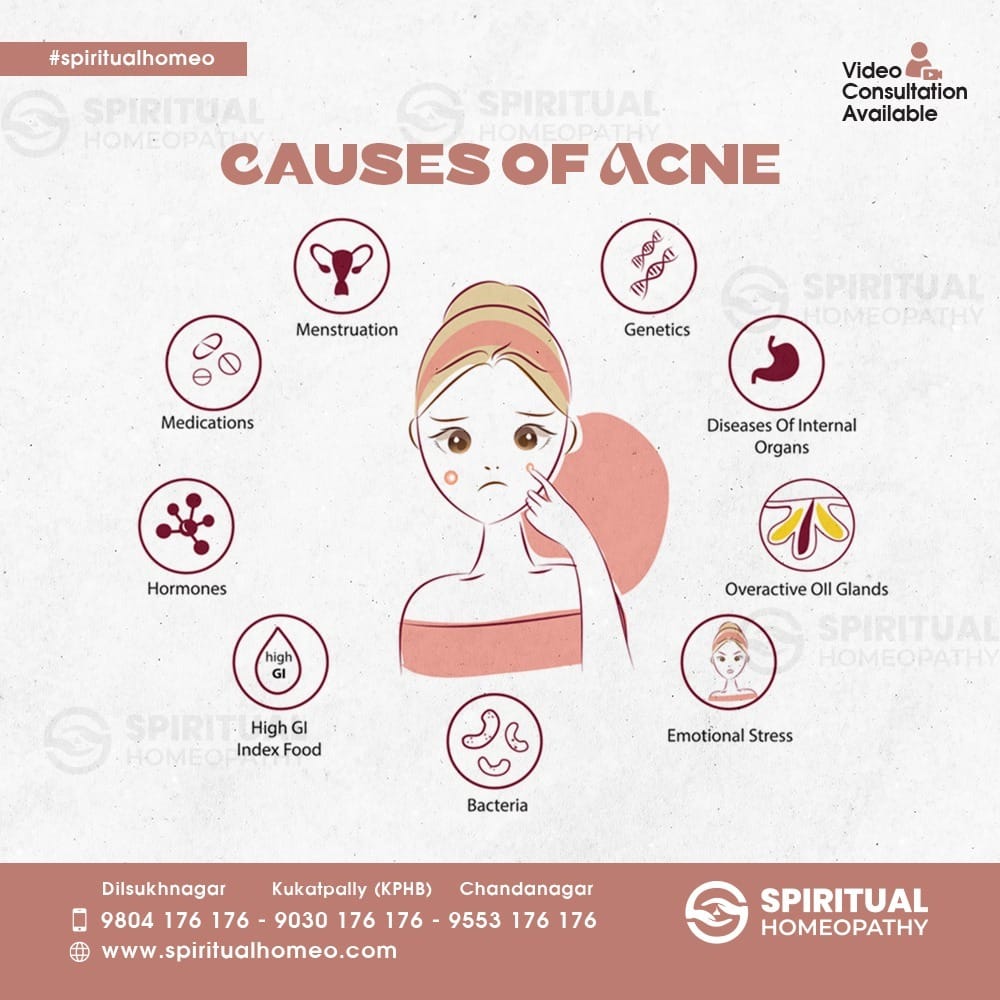 cause of acne