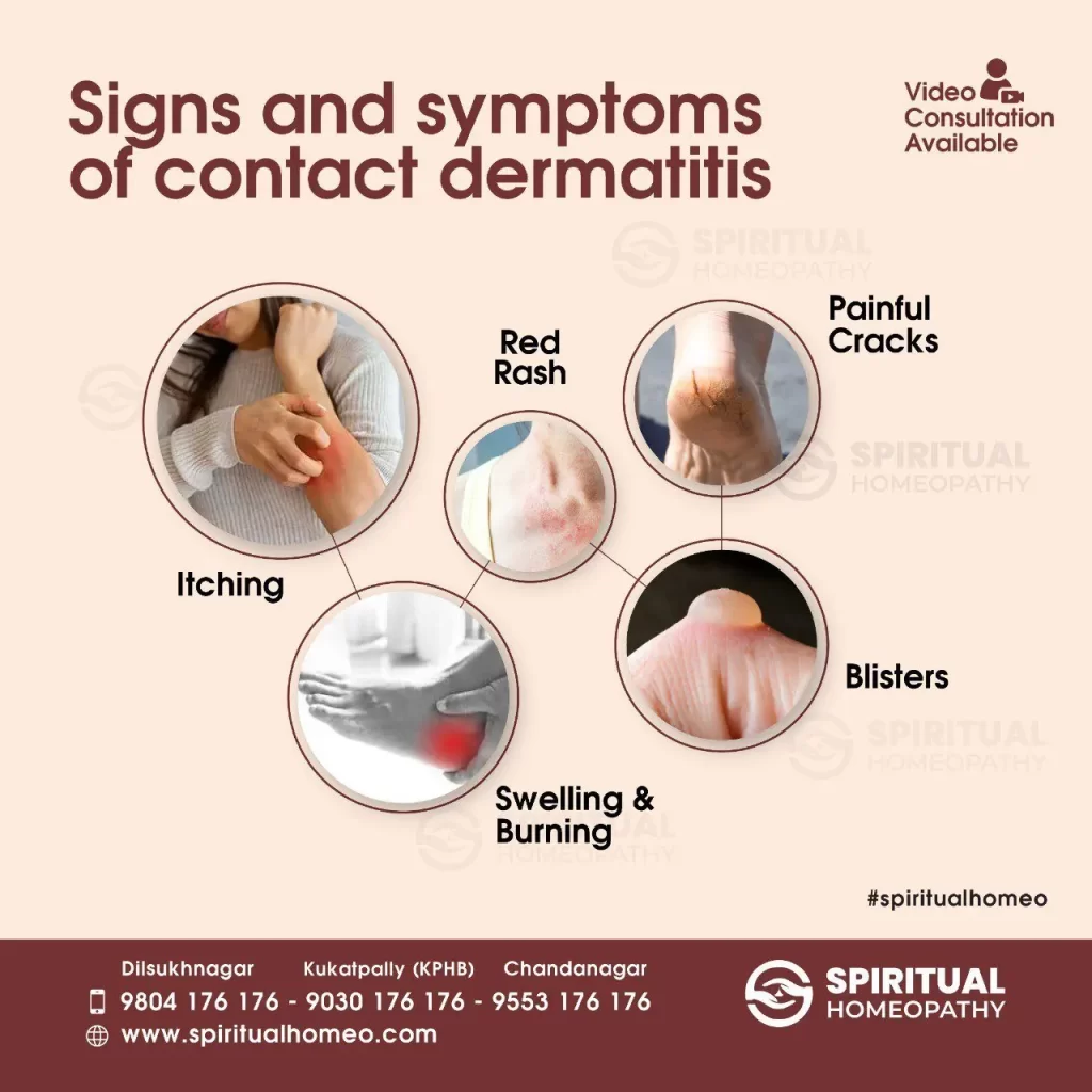 contact-dermatitis