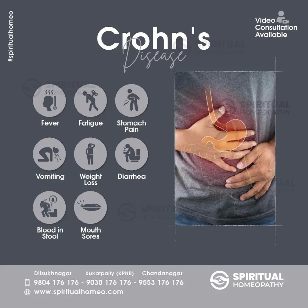 crohns-disease