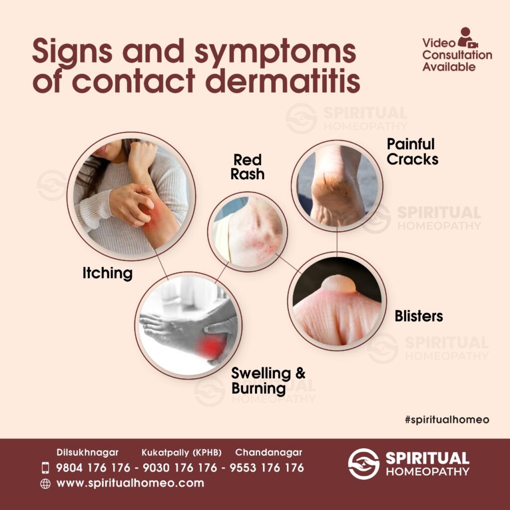 sign and symptoms of contact dermatitis