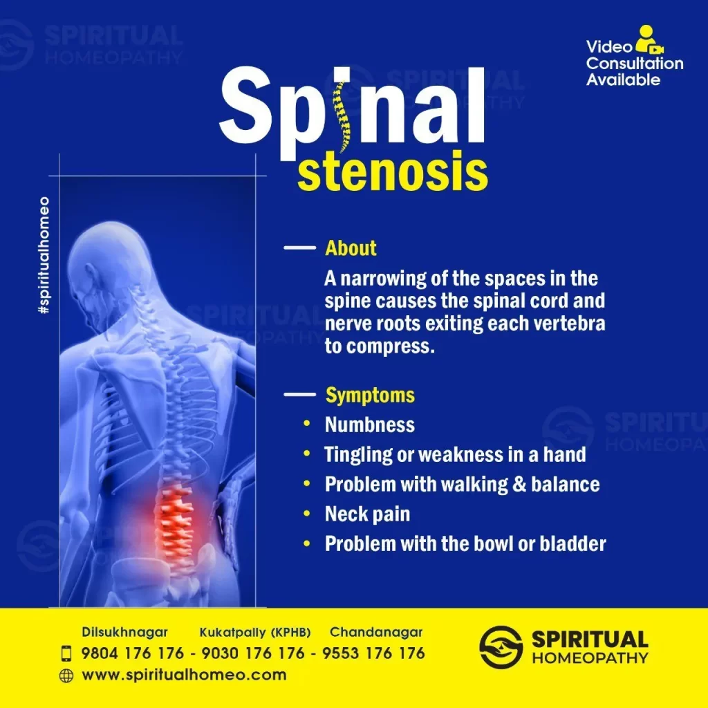 spinal-stenosis