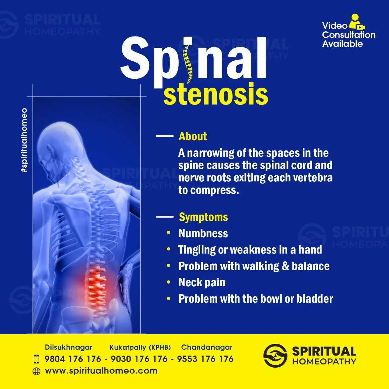 spinal-stenosis