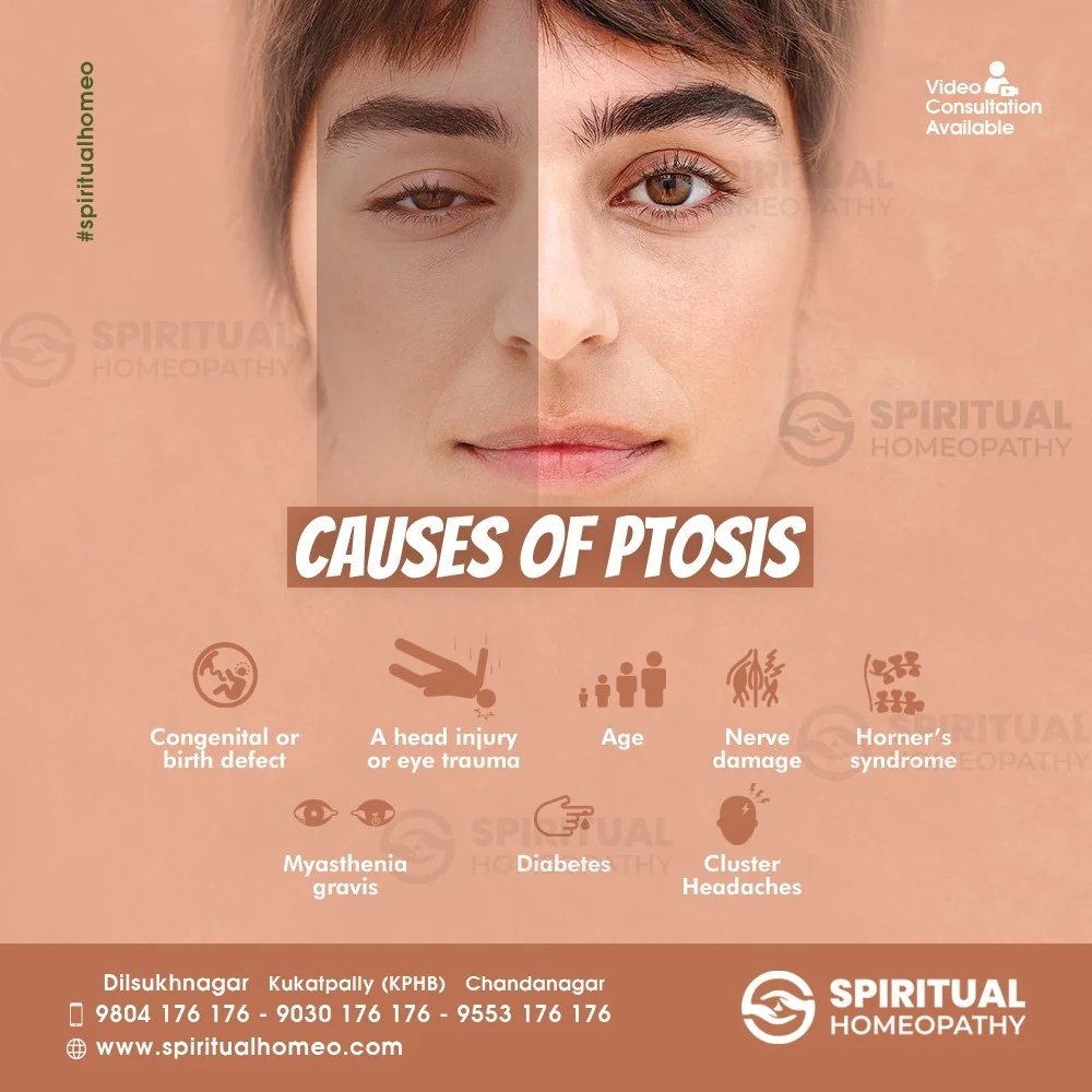 CAUSES-OF-PTOSIS