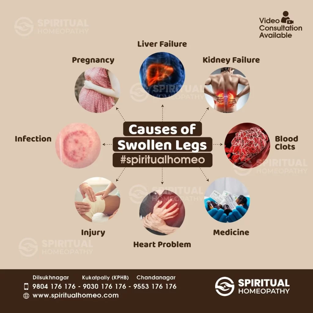 causes-of-swollen-legs