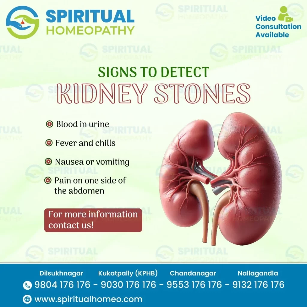 KIDNEY-STONES-P